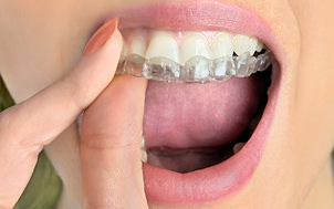 3DS(Dental Drug Delivery System)